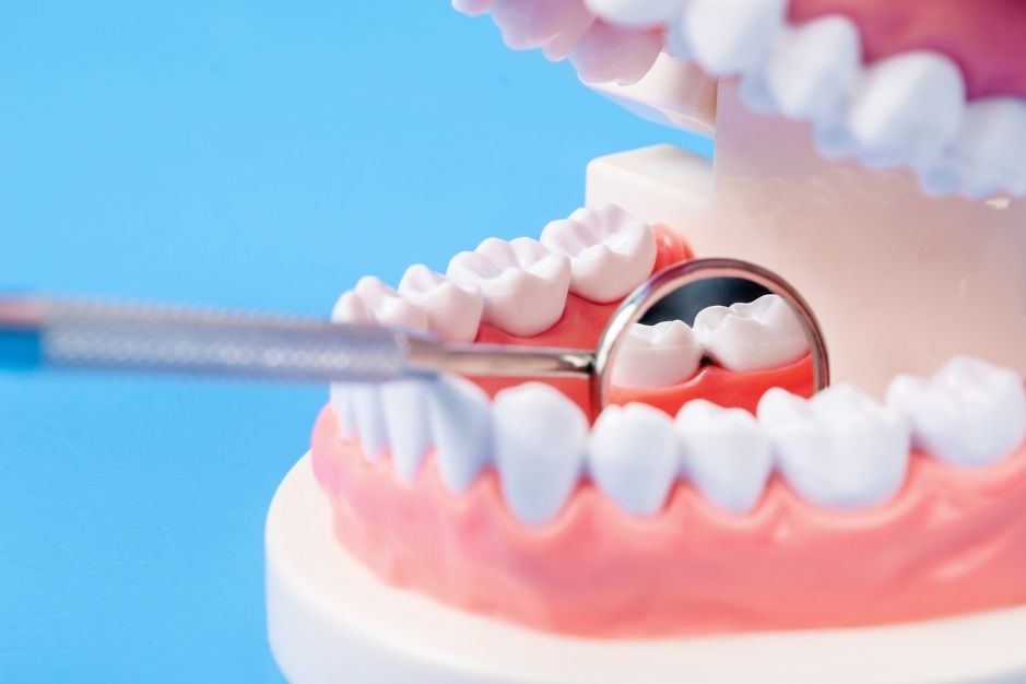 caries dental dentales dentistas linares De Torres y Polaina odontologos
